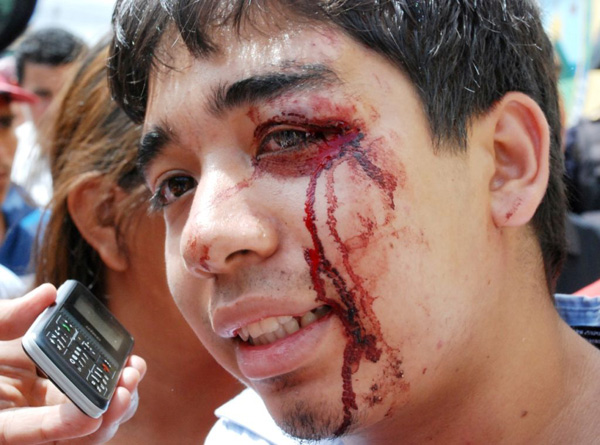 Injured student at a demonstration on July 30. Photo by Gilberto on Picasa.
